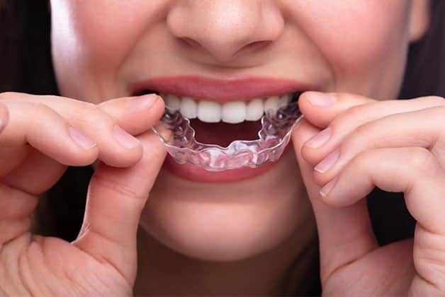 Invisalign vs braces: Liverpool dentist