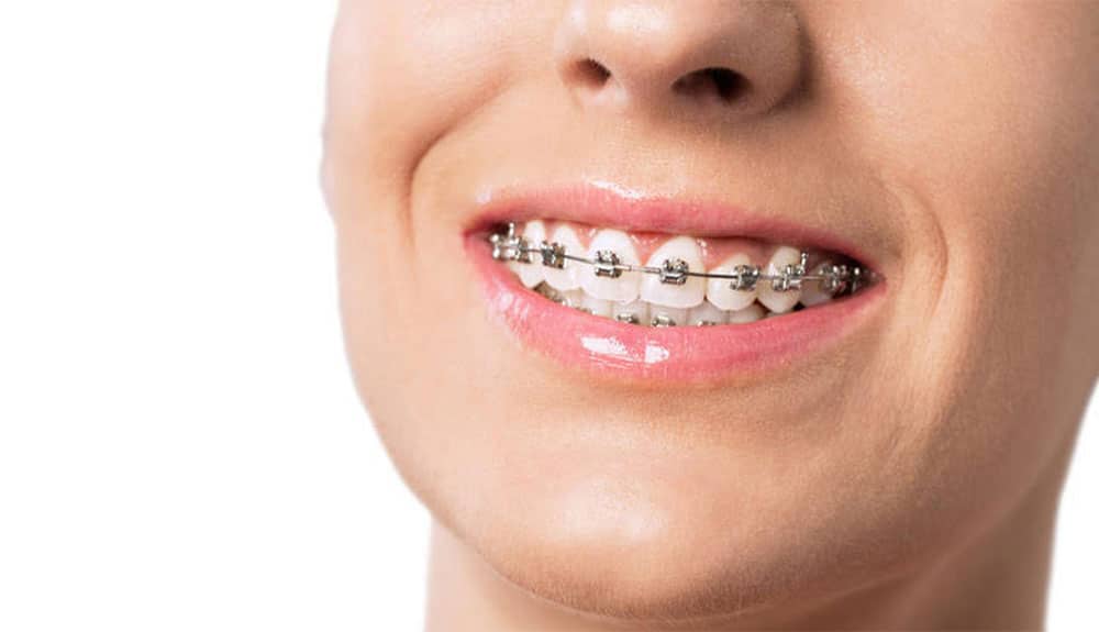Invisalign vs braces: Liverpool dentist