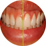 Teeth recontouring in Liverpool