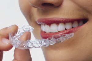 Invisalign braces - invisalign in liverpool