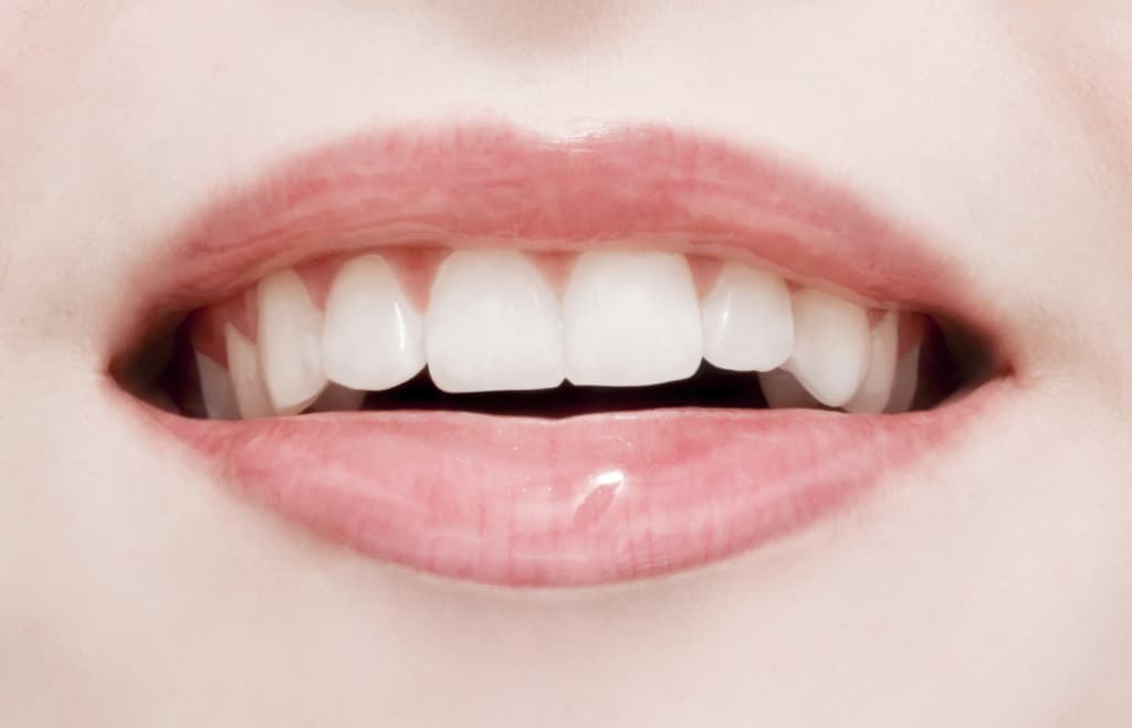 cosmetic veneers