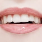 11 Things I Wish I’d Known Before I Got Composite Bonding