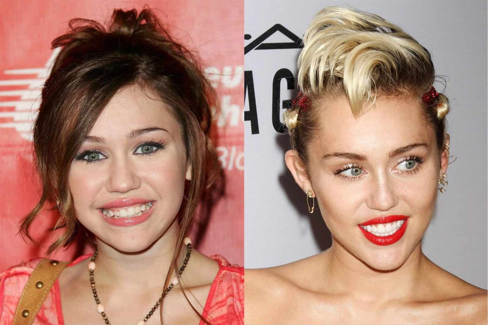 Celebrities That Have Had Composite Bonding & Veneers