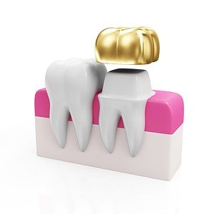 cosmetic dental crown gold