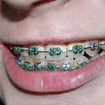 Braces for Teens