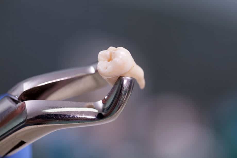 Wisdom tooth extraction Liverpool