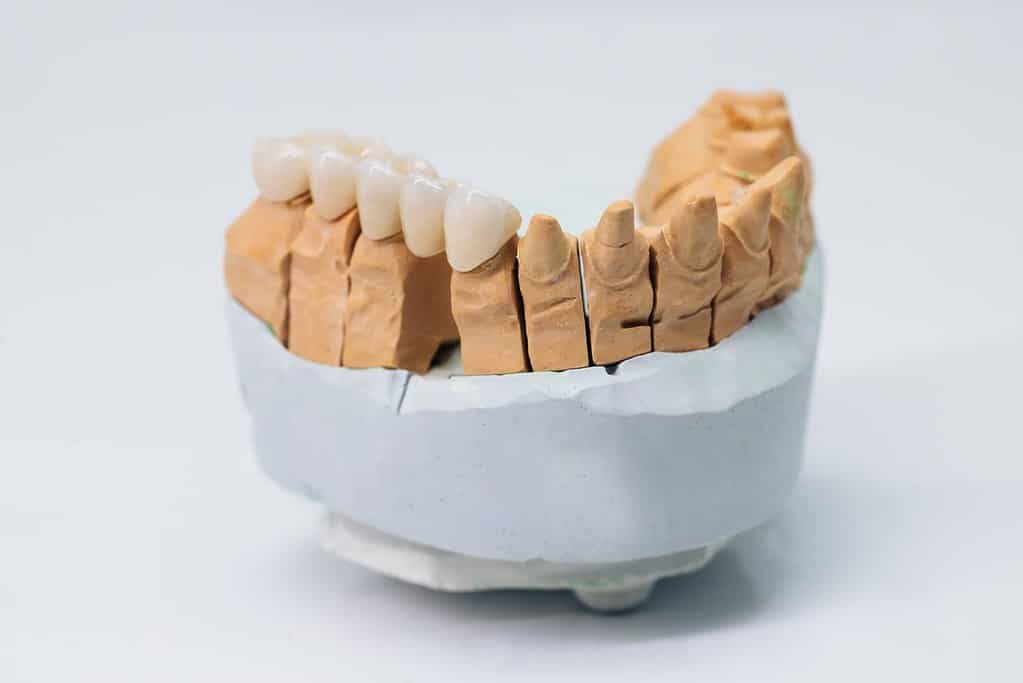 Liverpool dentist: When Are Veneers Recommended?