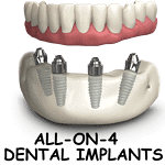 All-On-4 Dental Implants; Everything You Need to Know Before Opting for It