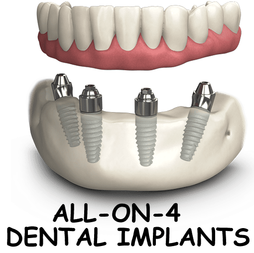 an image of 4 in 1 dental implants