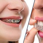 Invisalign vs Braces – What’s the Difference