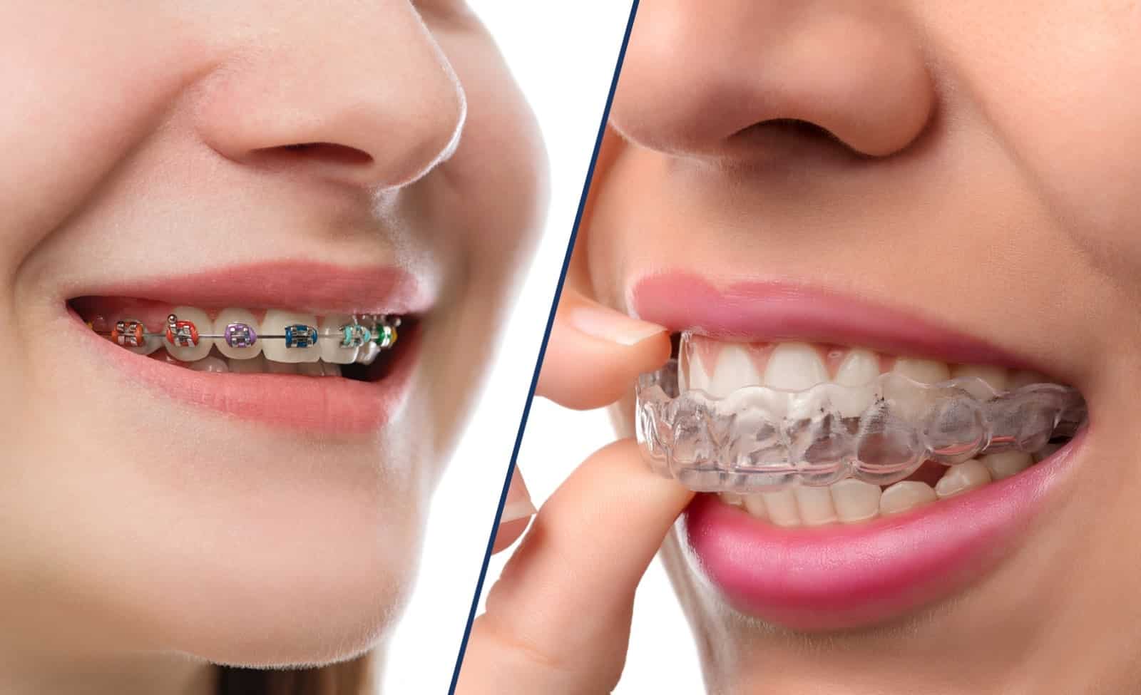 Comparison between braces and invisalign