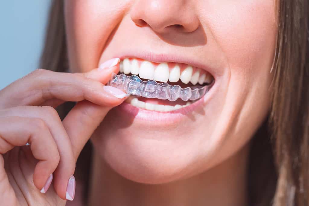 Invisalign dentist in Liverpool