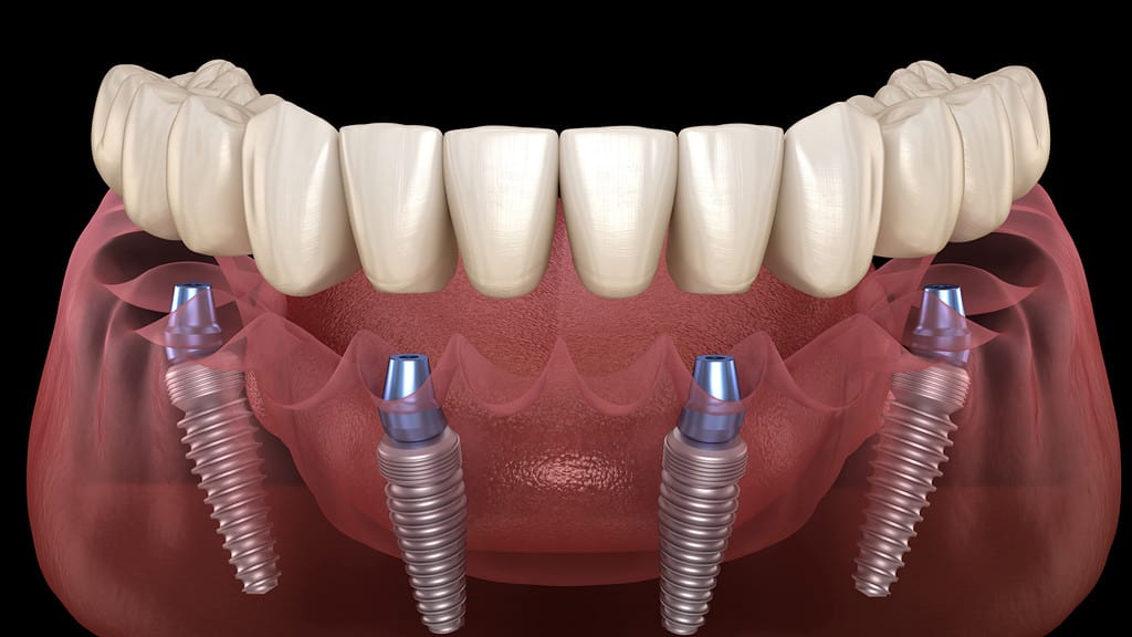 Same day teeth in Liverpool