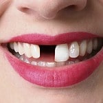 All On 4 Dental Implants in Liverpool – All You Need to Know!